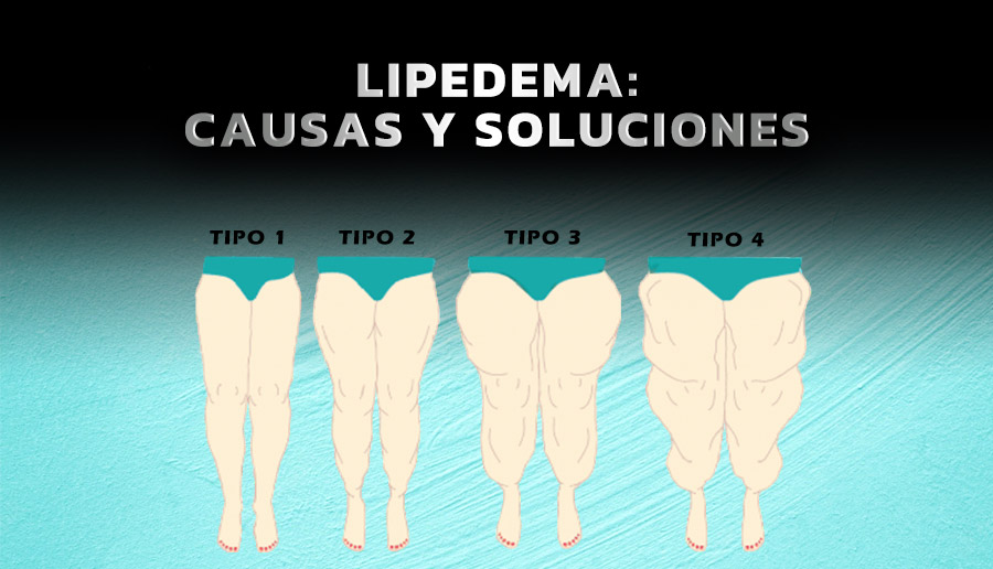 Lipedema, causas y soluciones